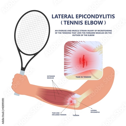 Tennis elbow pain inflammation tendon grip weak Golfer golf sport wrist brace tissue rupture limb arm