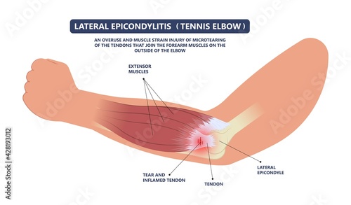 Tennis elbow pain inflammation tendon grip weak Golfer golf sport wrist brace tissue rupture limb arm