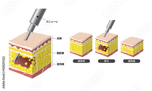 脂肪吸引（図）
