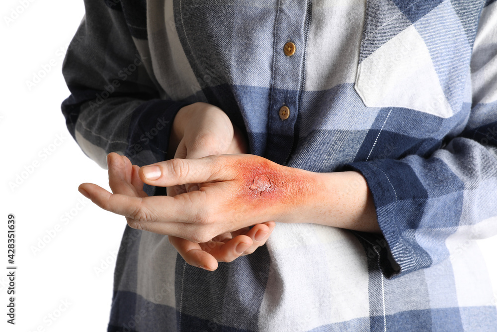 Woman with burn on her hand against white background, closeup
