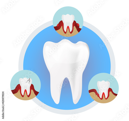White Teeth - Gum Disease - stock illustration