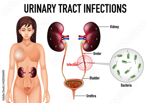 Information poster of urinary tract infections