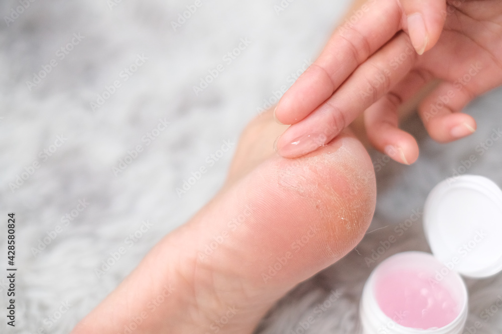 Woman applying dry skin gel on foot with carpet background, Health care concept. Woman applying dry skin gel on foot with carpet background, Health care concept.