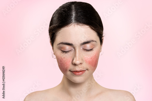 Portrait of a beautiful woman with her eyes closed, showing inflamed blood vessels on her cheeks. Pink background. Copy space. Rosacea treatment concept
