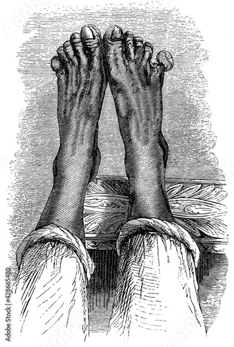 Gangrene of the feet. Illustration of the 19th century. Germany. White background.