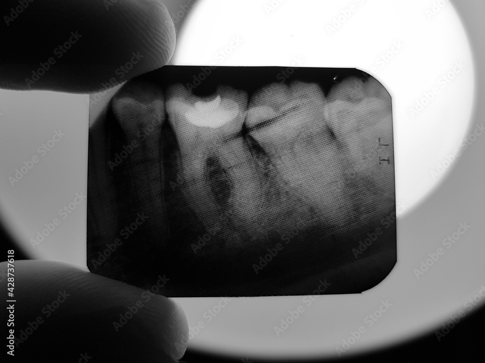 The result of x-ray radiography of the teeth of the oral cavity of the ...
