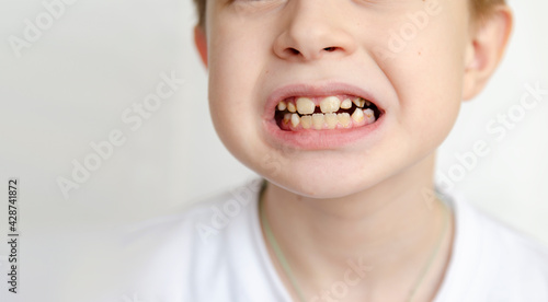 Hypoplasia of the enamel of the front teeth. Yellow plaque on the tooth enamel. Close-up.