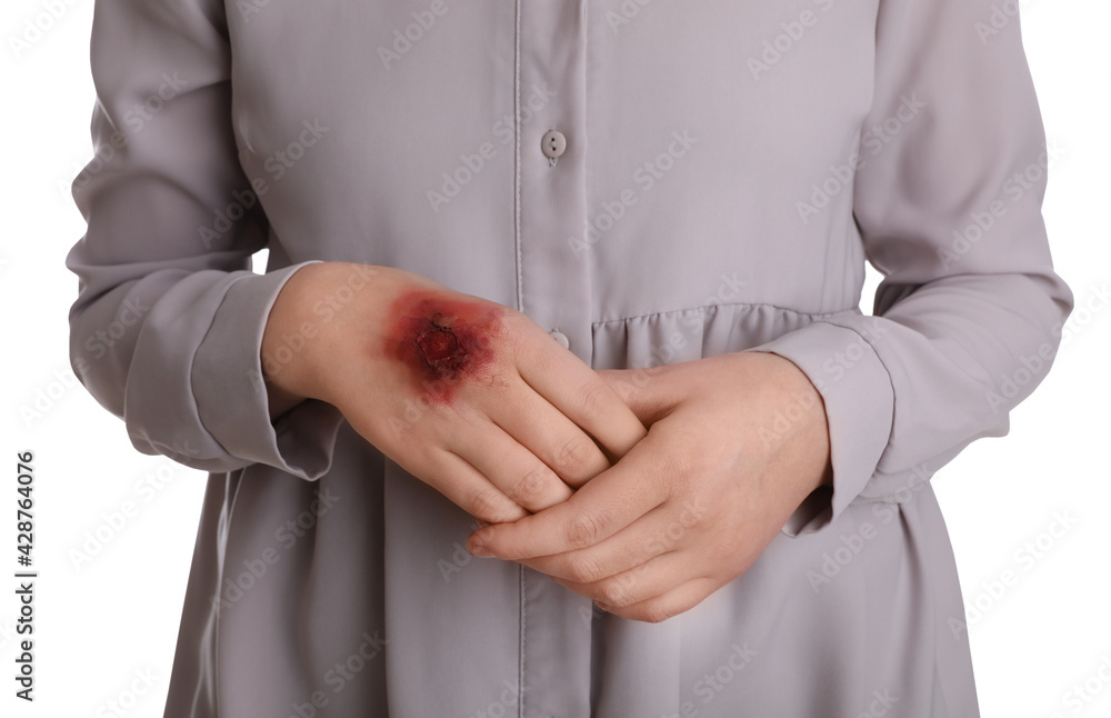Woman with burned hand on white background, closeup