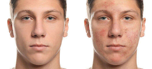 Collage with photos of teen guy with acne problem before and after treatment on white background. Banner design