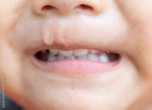 Tableau sur toile Picture of snot from the nose on the child's face