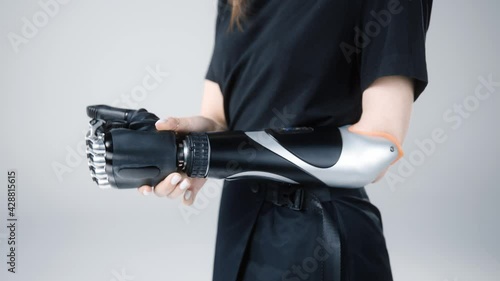 Girl with amputated hand connect Prosthetic artificial upper limb, BIONIC forearm photo