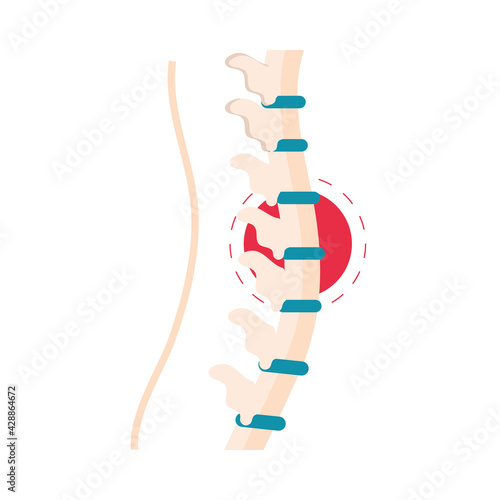 rheumatism vertebral column