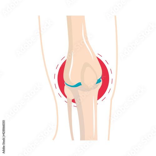 rheumatism knee swelling