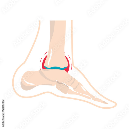ache arthritis rheumatology