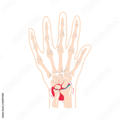 rheumatism bones pain