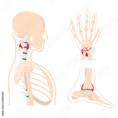 human bones arthritis