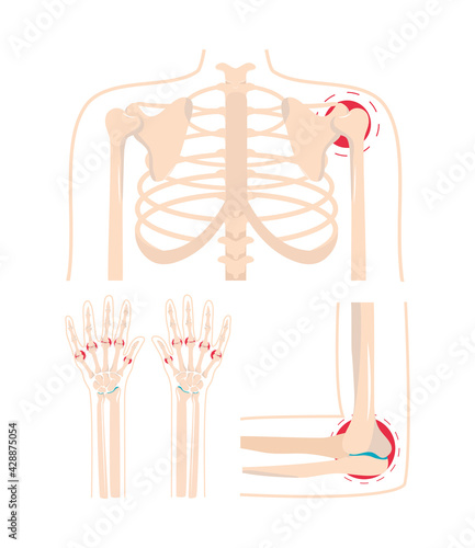 arthritis painful injury