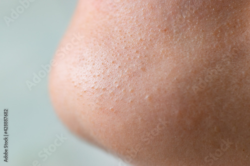 Macro close up in selective focus of a chin with large amount of blackheads and dilated pores. Blemishes of oily and combination skin. Rough face skin with blackheads in relief.