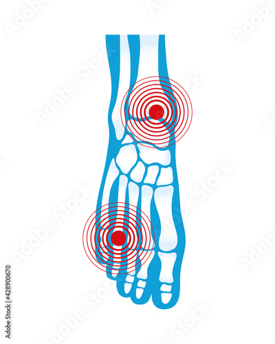 foot rheumatological pain