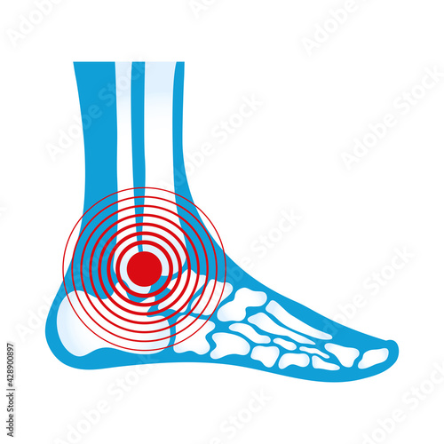 ankle rheumatological pain