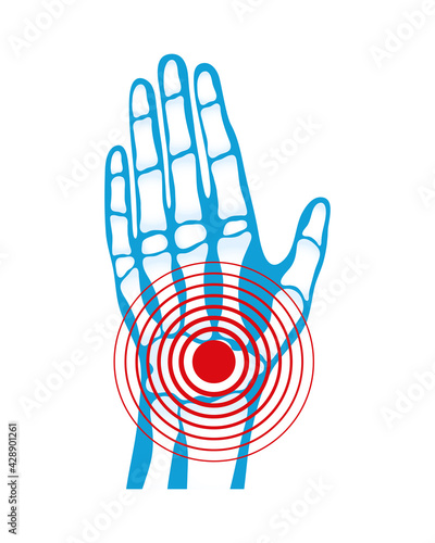 tunel carpal rheumatological pain