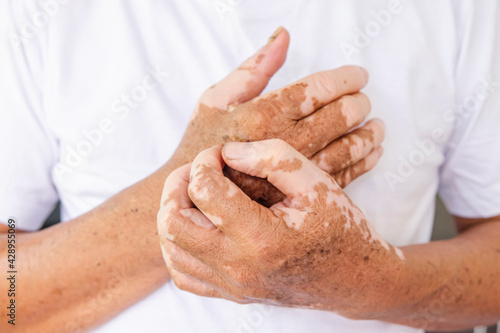 Close-up Vitiligo on skin hands of old people. medical condition causing depigmentation of patches of skin