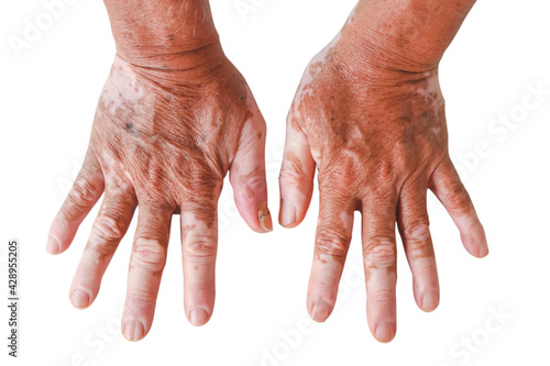 Close-up Vitiligo on skin hands of old people. medical condition causing depigmentation of patches of skin. isolated White background