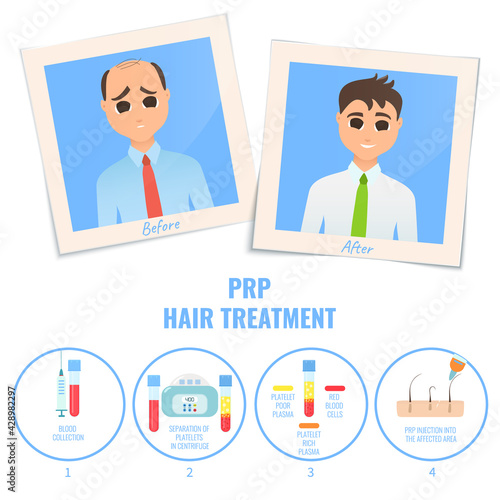 Photographs of a man before and after PRP treatment. Platelet rich plasma procedure stages. Male hair loss design template. Alopecia medical concept. Vector illustration.