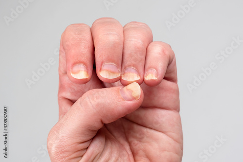 Onychomycosis or fungal nail infection on damaged nails after gel polish, onychosis. Longitudinal ridging nails with psoriasis, nail diseases. Health and beauty problem
