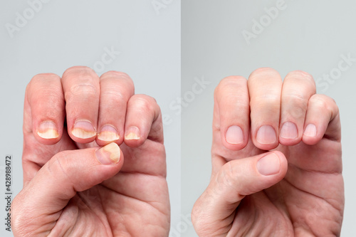 Before and after successful treatment for a onychomycosis or fungal nail infection on damaged nails after gel polish, onychosis. Longitudinal ridging nails with psoriasis, nail diseases. photo