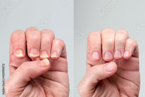 Before and after successful treatment for a onychomycosis or fungal nail infection on damaged nails after gel polish, onychosis. Longitudinal ridging nails with psoriasis, nail diseases.