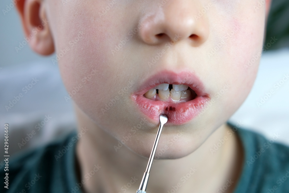 dentist, doctor examines oral cavity of small patient, lip burst, blood on the wound, molars
