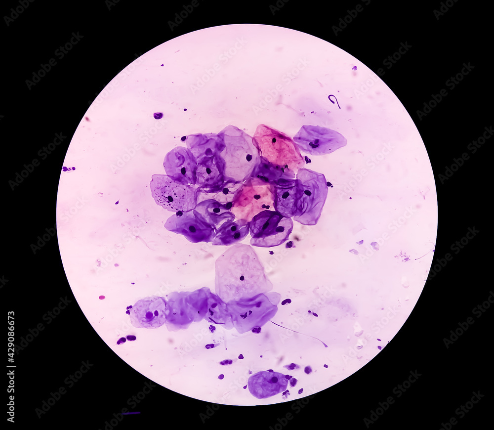 Под микроскопом смотрят шейку Dysplasia Cells Stock Photos, Pictures & Royalty-Free Images iStock