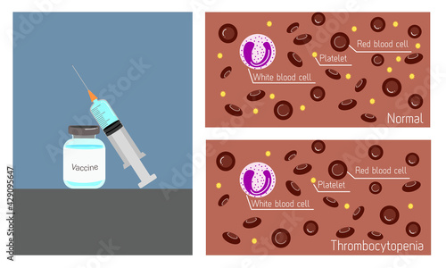 histopathology illustration of thrombocytopenia (low platelet count) condition induced by vaccination compare to normal blood condition photo