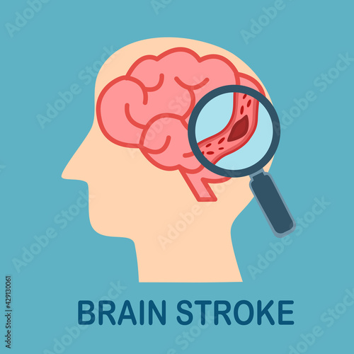 Magnifying human brain stroke problem in flat design. Brain disease. 