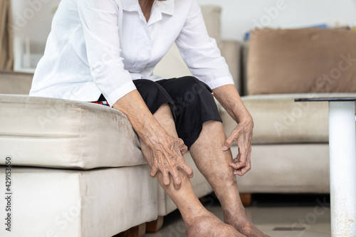 Fotografie Hands of old elderly scratching legs,itching from mosquitoes,insect bites allerg