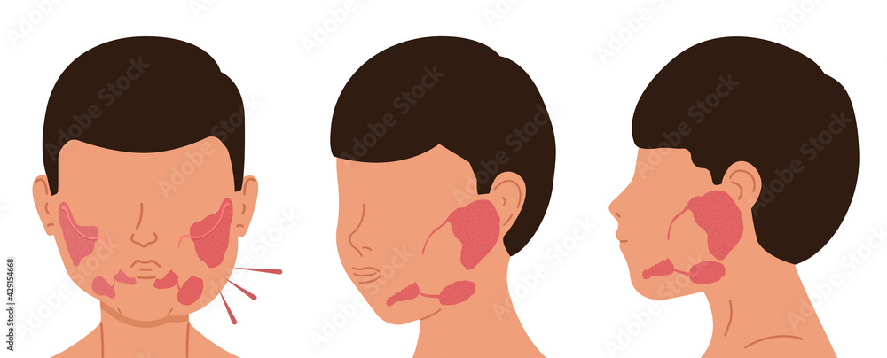 Person with sick and healthy salivary glands. Vector illustration of sialolithiasis. Person with sick and healthy salivary glands. Vector illustration of sialolithiasis.