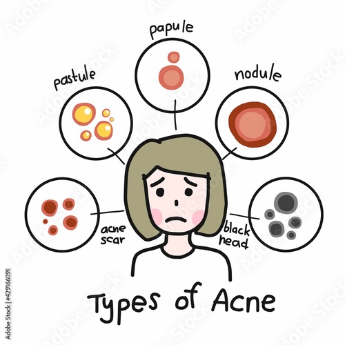 Type of acne , Cute woman cartoon face vector illustration