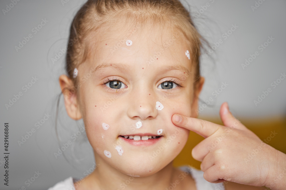 Portrait of smilling little child girl with chickenpox. Sick toddler with varicella virus or Chickenpox bubble rash on home isolation Portrait of smilling little child girl with chickenpox. Sick toddler with varicella virus or Chickenpox bubble rash on home isolation