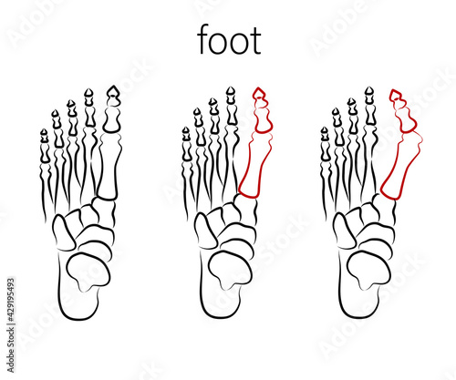 Human foot. Improper bone fusion. Symbol. Vector illustration.
