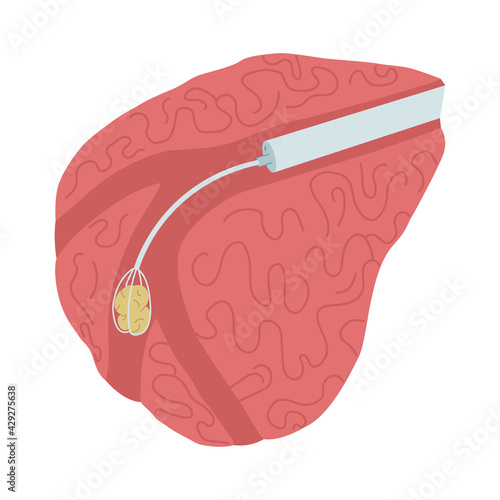 Vector illustration of endoscopic surgery to remove a stone from the salivary gland. Sialendoscopy