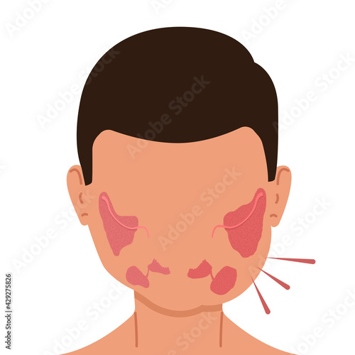 A person with inflamed salivary glands. Medical vector illustration.