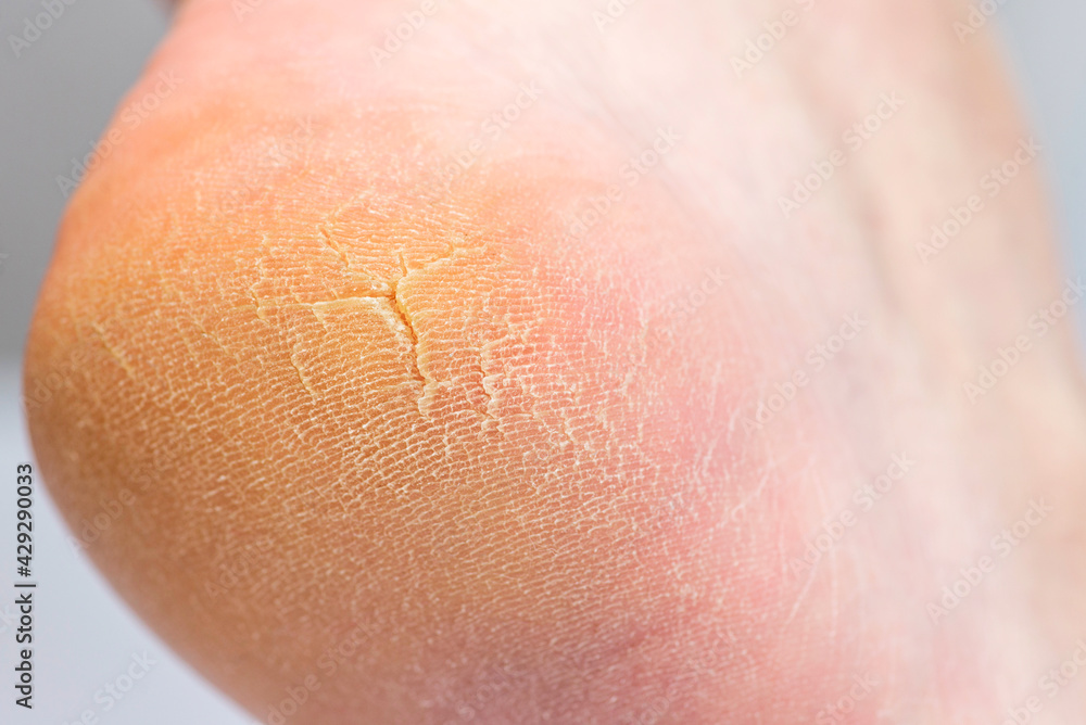 Close up of cracks on the heels. A persons heel with dry skin and cracks Close up of cracks on the heels. A persons heel with dry skin and cracks