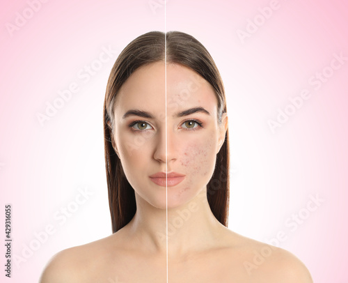 Young woman with acne problem before and after treatment on light background, collage