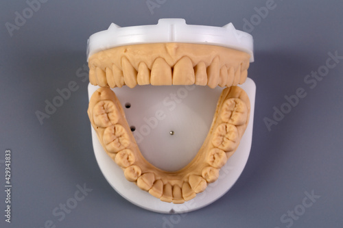 Mold of teeth. Gypsum model plaster of teeth. Stomatologic plaster cast, molds of human jaws and teeth on gray background. Dentistry and orthodontics concept photo