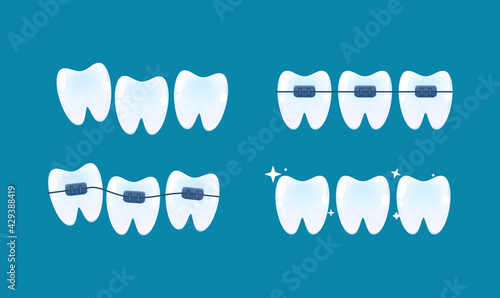 Alignment of teeth and bite correction with the help of braces system. Vector cartoon style.