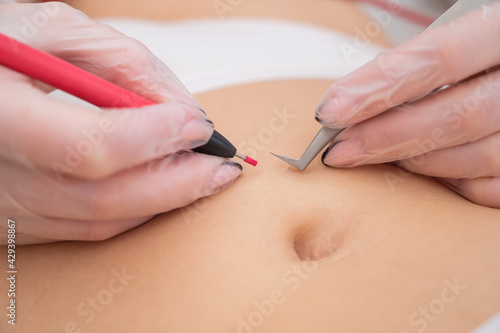 Woman on electro epilation on her tummy. Permanent hardware removal of unwanted abdominal hair.