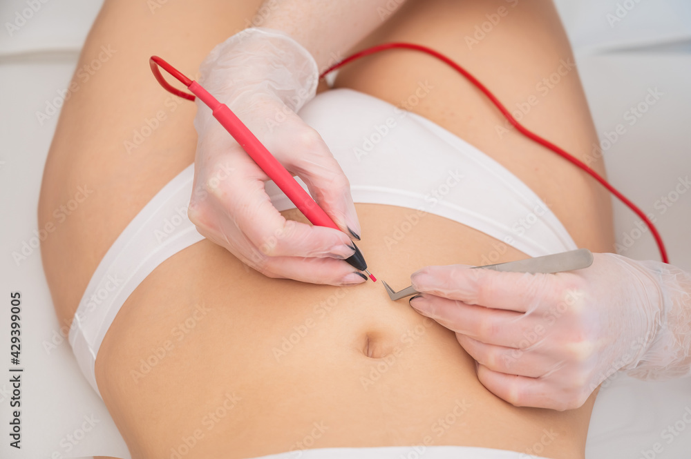 Woman on electro epilation on her tummy. Permanent hardware removal of  unwanted abdominal hair. Photos | Adobe Stock