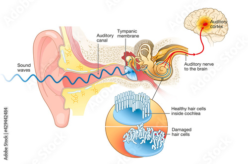 Tinnitus. Damaged hair cells inside cochlea photo