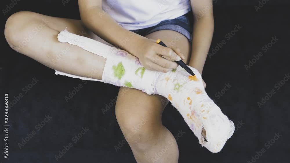Teenage girl draws on a leg in a cast. A way to have fun with a broken